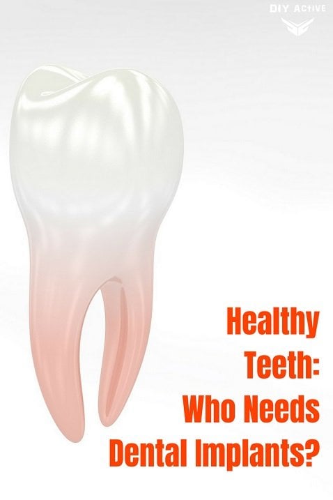 Healthy Teeth Who Needs Dental Implants Today