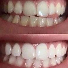 Best Teeth Whitening Product On the Market Today