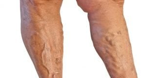 Dietary Tips for Treating Varicose Veins Faster