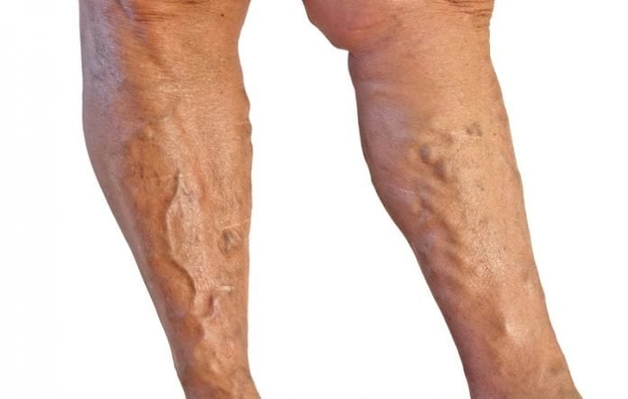 Dietary Tips for Treating Varicose Veins Faster