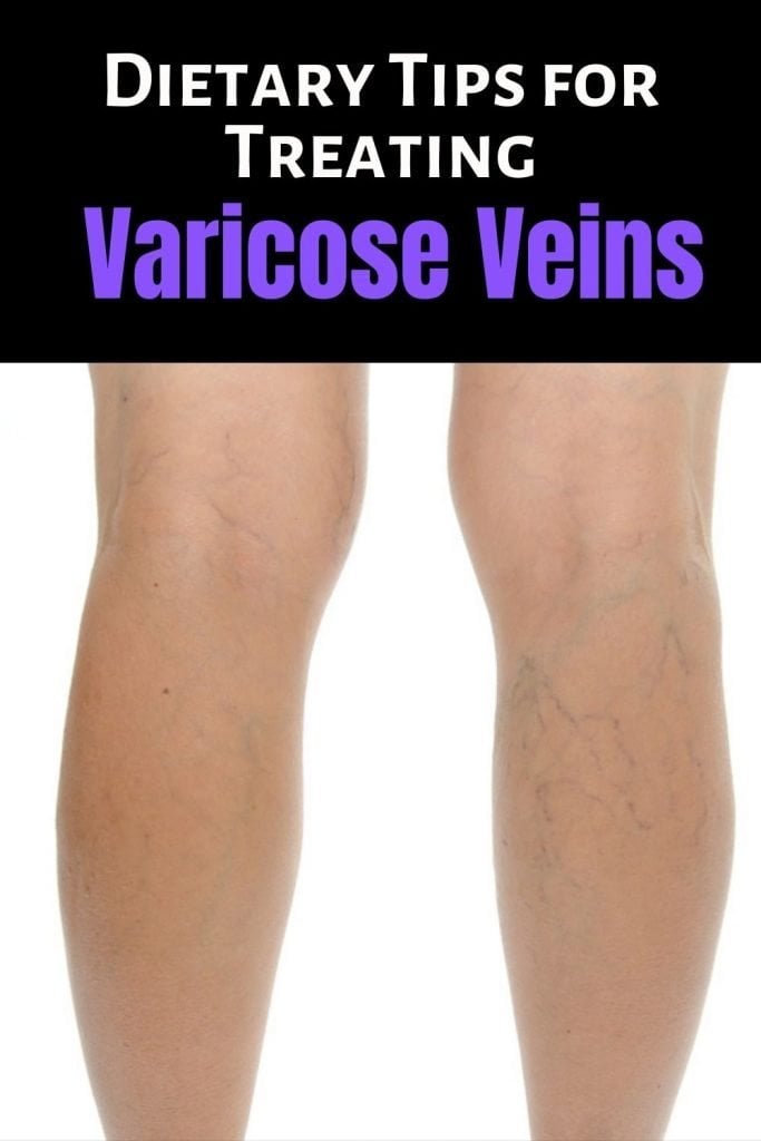 Dietary Tips for Treating Varicose Veins Faster Today