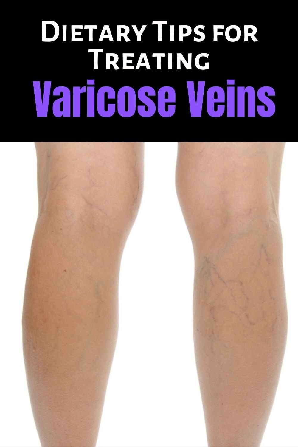 Dietary Tips for Treating Varicose Veins Faster