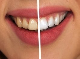 Best Teeth Whitening Kit GLO Science Vs. SNOW