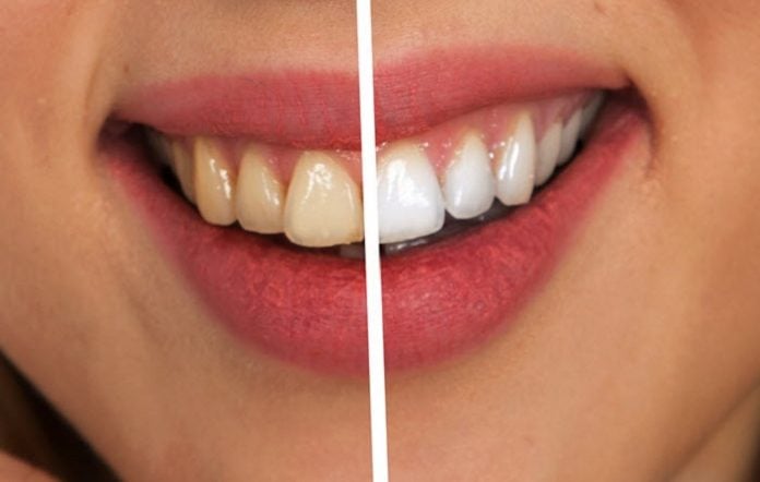 Best Teeth Whitening Kit GLO Science Vs. SNOW