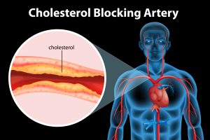 Will Weight Loss Lower Cholesterol? 