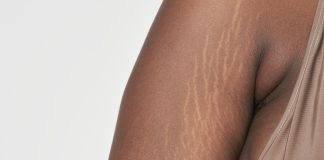 Can Weight Loss Cause Stretch Marks?