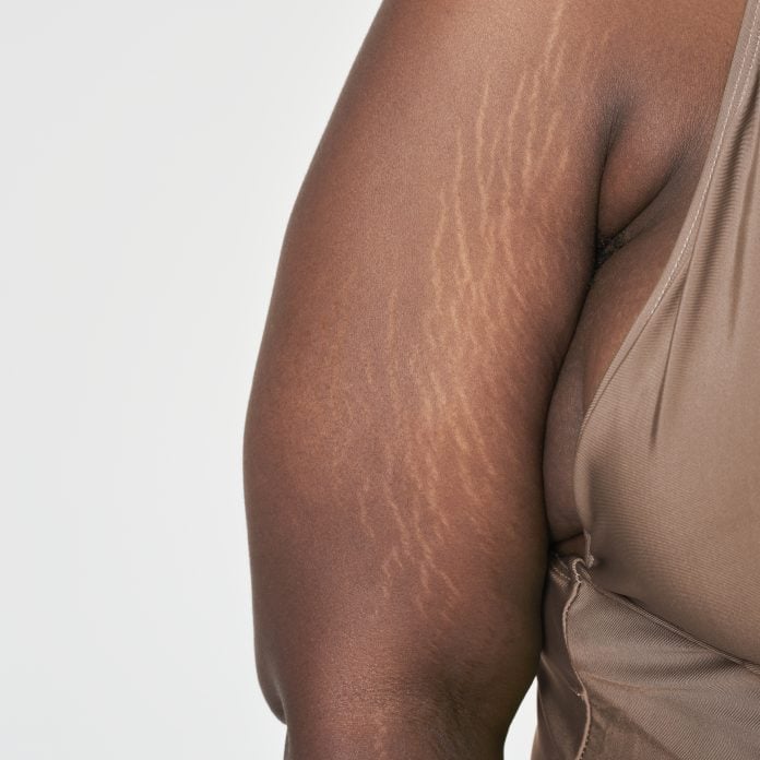 Can Weight Loss Cause Stretch Marks?